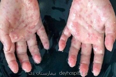 یک فرد مبتلا به علایم آبله میمون در بابل شناسایی شد