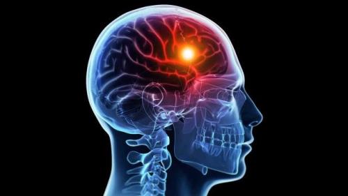 شایع ترین عوامل بروز سکته مغزی