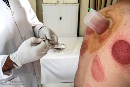 حجامت در چه صورت مفید می باشد