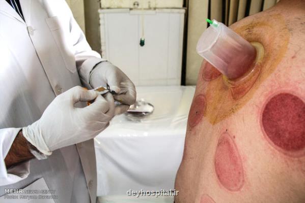 حجامت در چه صورت مفید می باشد