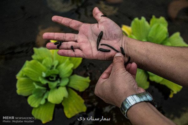 چه کسانی نباید سراغ زالودرمانی بروند
