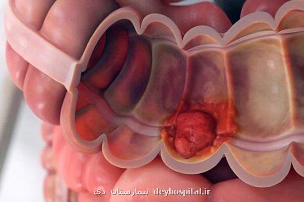 تشخیص زودهنگام سرطان روده با کاهش سن غربالگری