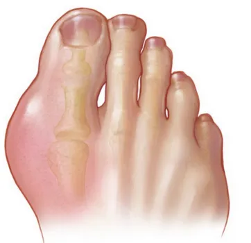 نقرس چیست و درمان اصولی آن چه طور است؟