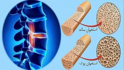 استعمال دخانیات و مصرف کورتون سبب افزیش احتمال مبتلا شدن به پوکی استخوان می شود