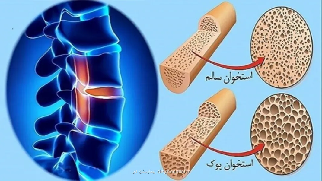 استعمال دخانیات و مصرف کورتون سبب افزیش احتمال مبتلا شدن به پوکی استخوان می شود