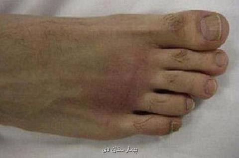 دلیلهای انحراف انگشت شست پا، ۱۵۰ نوع روش جراحی